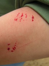 animal bite